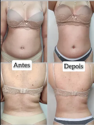 Antes e depois — Abdômen