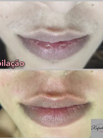 Antes e depois — Buço