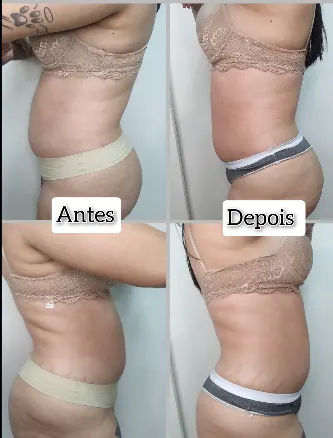Antes e depois — Lateral & Flancos